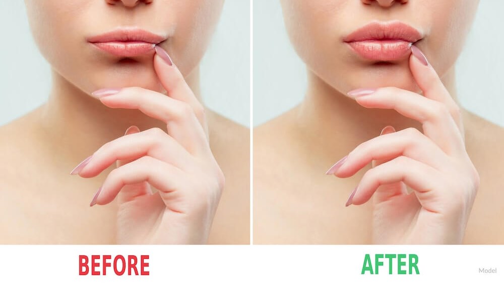 Before and After Lips